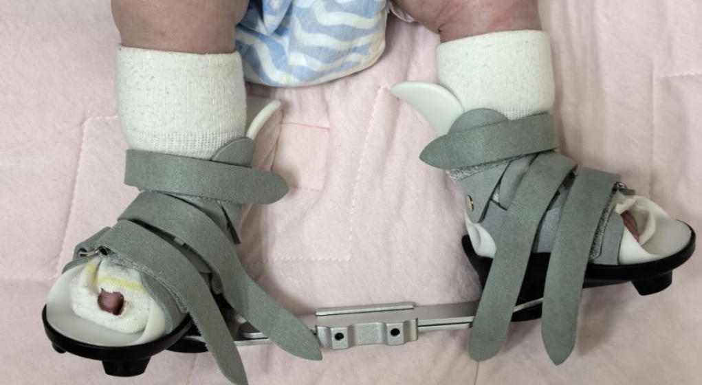 莫慌张！规范治疗可康复，新生儿患者成功矫正“马蹄足”